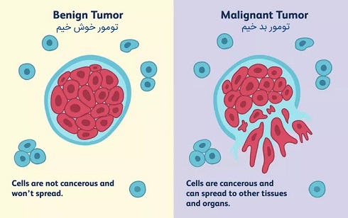 تشخیص توده خوش‌خیم و سرطانی