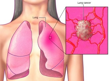 ابتلا به سرطان ریه