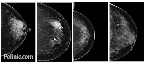 تصویر ماموگرافی برای تشخیص سرطان سینه
