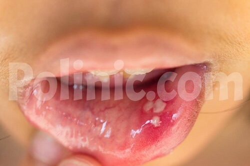 زخم در دهان ویروس HPV