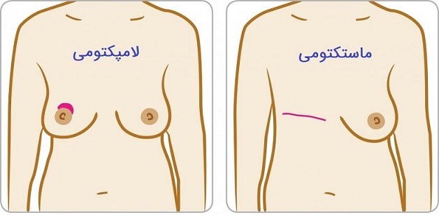 فرق بین ماستکتومی و لامپکتومی