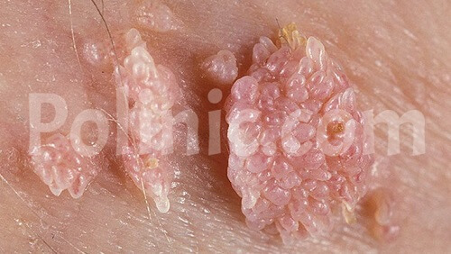 زگیل تناسلی ویروس HPV