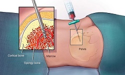 آسپیراسیون و بیوپسی مغز استخوان