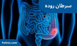 همه چیز در مورد سرطان روده همه چیز در مورد سرطان روده